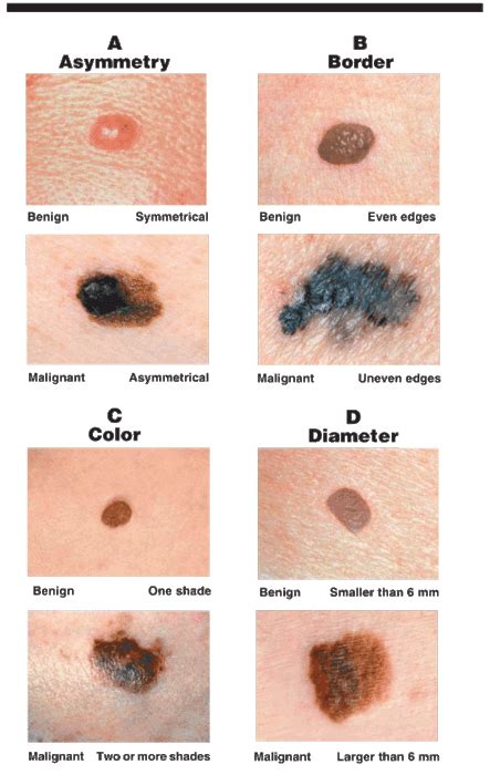 Characteristics Of Cancerous Moles Op Good To Know I Have Tons