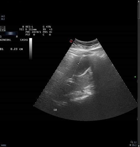 Cureus Atypical Presentation Of Perforated Viscus As Biliary Colic