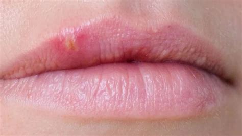 Bumps On Lips Cause And Treatment At Spring Orchid