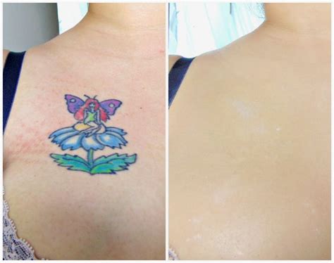 17 Best Images About Skin Camouflage Before And After On Pinterest