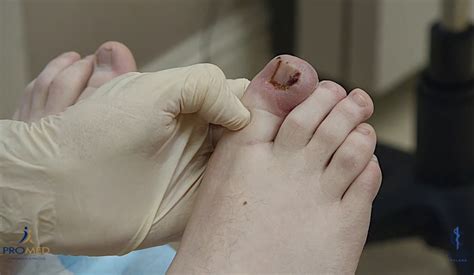 Wedge Resection And Nail Bed Ablation For Ingrown Toenails Kerry Skin