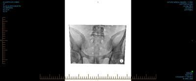 Lower back pain with shooting pain down the entire leg
