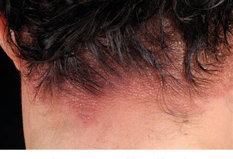 Figure 1 From Allergic Contact Dermatitis Semantic Scholar