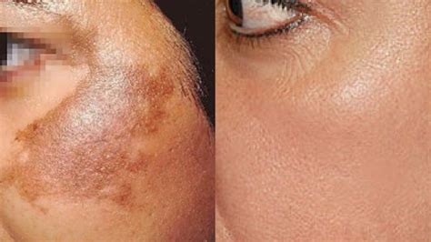 Pigmentation Melesma Sun Spots Treatment Perfection Cosmetic