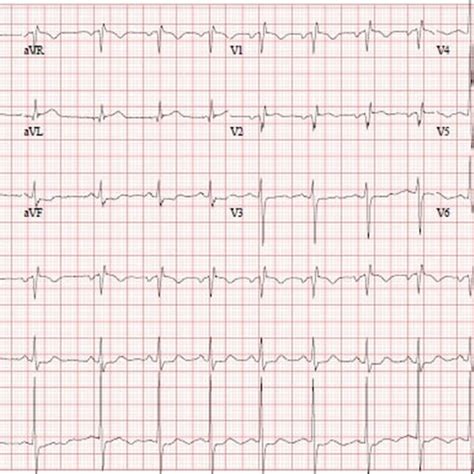 Twelve Lead Electrocardiogram Ekg Showed 2 Mm St Depression In Lead