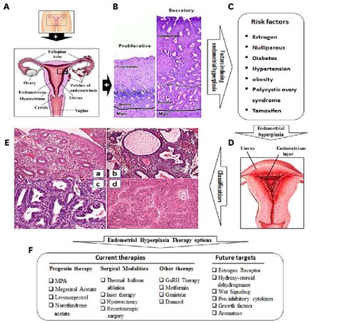 Overview Of Endometrial Hyperplasia Risk Factors Classification And