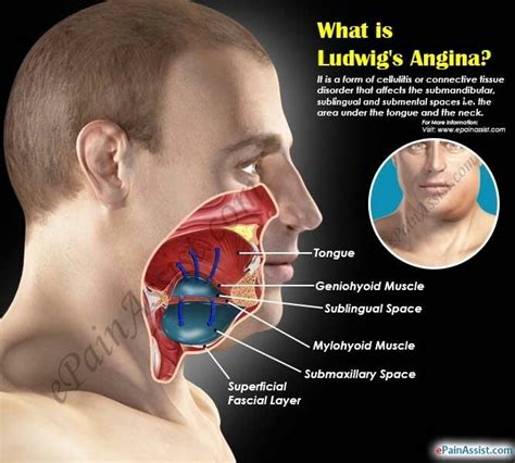 Ludwig Angina Gs Mouth Dental Infection Tooth Infection Medical Anatomy