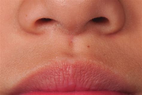 Photograph Of The Patients Upper Lip At Five Months Shows A Small