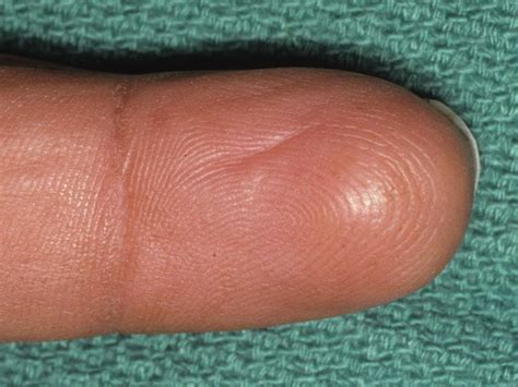 Giant Cell Tumor Finger