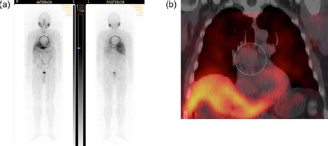 Planar A And Coronal Spect Ct B Images From The I 123 Mibg Scan