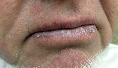 Derm Dx Scaling On The Lower Lip Clinical Advisor
