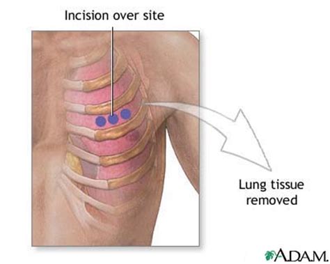 Incision For Lung Biopsy MedlinePlus Medical Encyclopedia Image