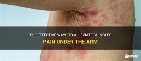 The Effective Ways To Alleviate Shingles Pain Under The Arm Medshun