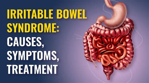 Irritable Bowel Syndrome Ibs Symptoms And Treatment Mfine Youtube