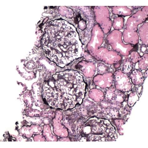 Light Microscopy Of Renal Biopsy With Jones Silver Stain Download