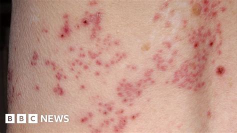 Shingles Vaccine Has Cut Cases By A Third In England Bbc News