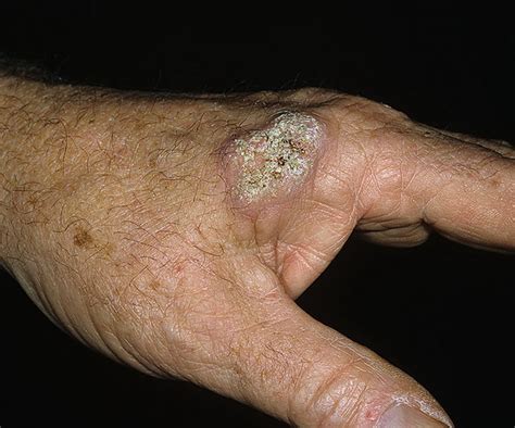Skin Cancer Lesions On Arms