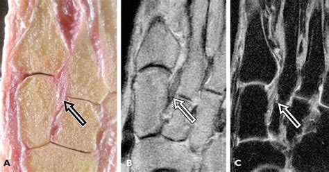 Lisfranc Joint Ligamentous Complex Mri With Anatomic Correlation In