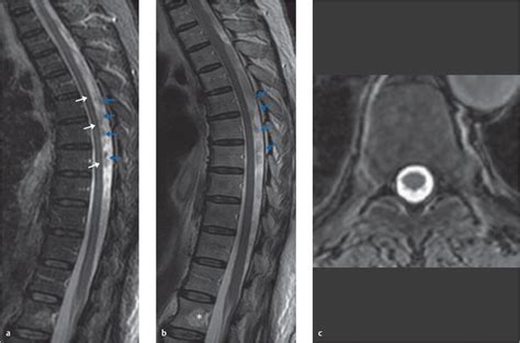 MRI Patient Related Motion Artifacts Radiology Key