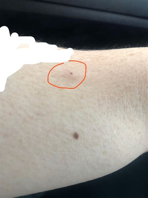 Hard Lump On My Shin Sudden Onset Rlipoma