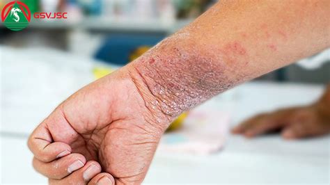 BỆnh Eczema Herpeticum CÓ Nguy HiỂm KhÔng Công Ty Cổ Phần Gsv Việt Nam