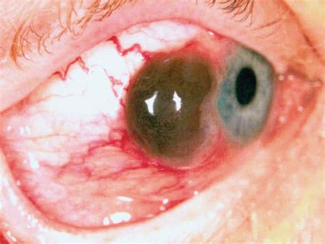 Conjunctival Melanoma With A Positive Sentinel Lymph Node External