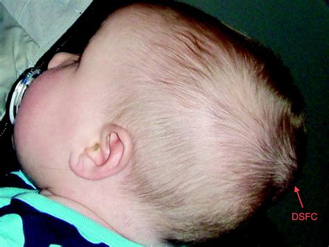 Experiences Of Parents Caring For Infants With Rare Scalp Mass As