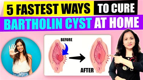 5 Ayurveda Tips To Cure Bartholin Cyst Cure Bartholin Cyst At Home
