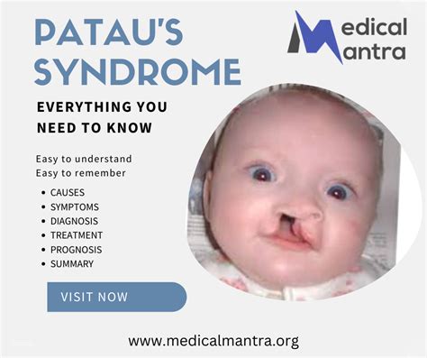 Pataus Syndrome Trisomy 13 Causes Symptoms Diagnosis Treatment And Management