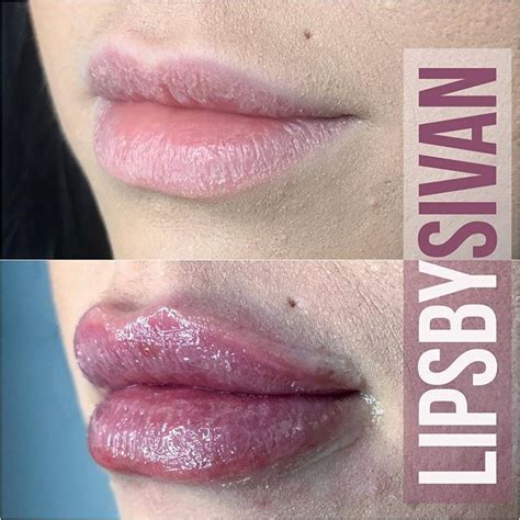 This Is A Full Lip Plump With 1 Syringe Of Juvedermxc Ultra I Added
