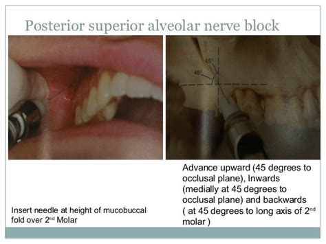 Anatomical Correlation Of Local Anesthesia In Dentistry