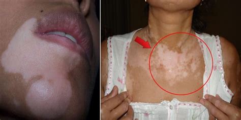 Do You Have White Spots On Your Skin Heres What They Are And How To