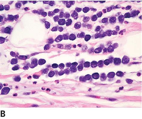 Mast Cell Tumors Veterian Key