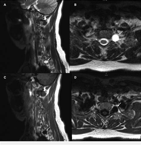 Cervical Spine Mri With Contrast