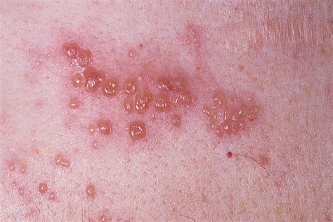 Skin Herpes Pictures Photos