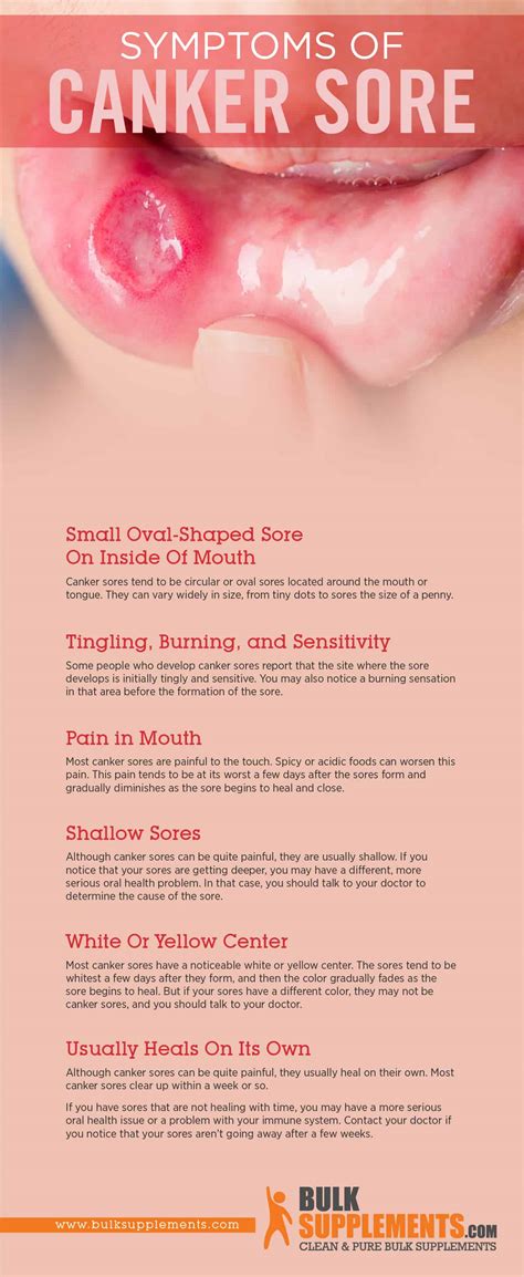 Tablo Read Canker Sores Symptoms Causes And Treatment By
