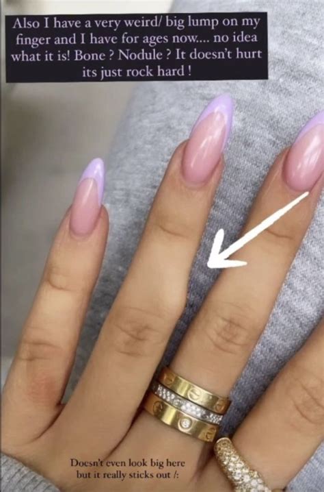 Molly Mae Hague Asks Fans For Help After Spotting Lump On Finger