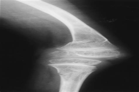 Severe Osteopenia With Recurrent Fractures After Bone Marrow Journal Of Pediatric Orthopaedics
