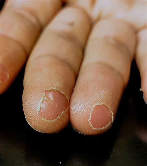 fingertip peeling causes remedies and prevention nails ball exercises remedies