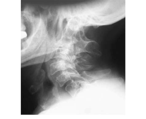 Plain Lateral Radiograph Of Cervical Spine Reveals Notable Degenerative