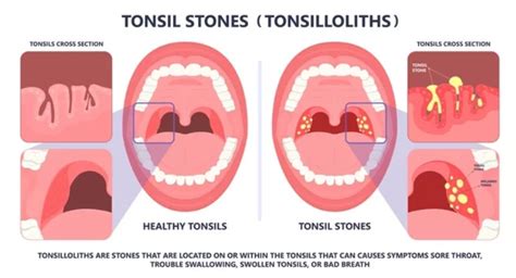 What Are Tonsil Stones And Why Do They Cause Bad Breath Dr Sharad
