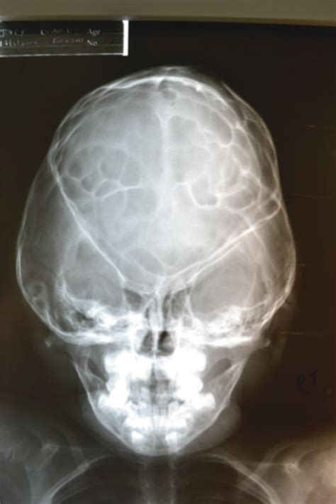 Intraventricular Hemorrhage And Post Hemorrhagic Hydrocephalus Neupsy Key