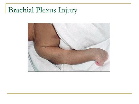 Brachial Plexus Injury In Newborn Ppt