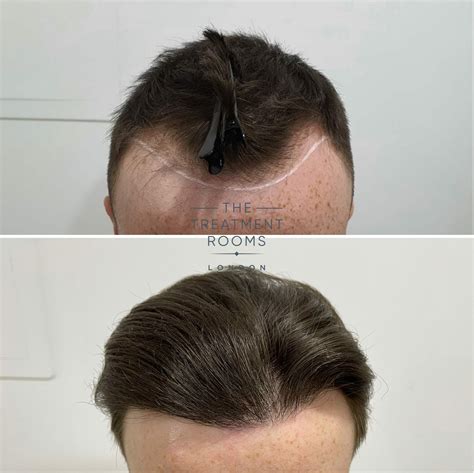 FUE Hair Transplant 1259 Grafts Treatment Rooms London