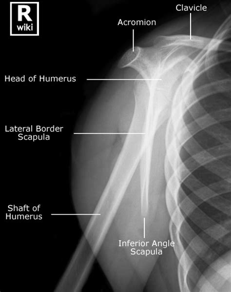 Paediatric Shoulder Wikiradiography