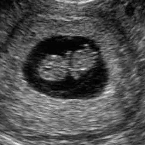 Baby Ultrasound Images Week 9