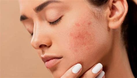 Yes Dry Skin Breaks Out Too Here Are 4 Ways To Manage It According To