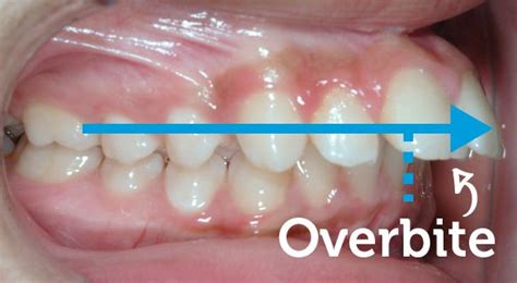 Learn about the role of braces in correcting overbites, as well as other overbites, or malocclusions, are the overlap of the upper teeth in relation to the lower teeth. Overbite corrected with braces · Smile Logic Orthodontics ...