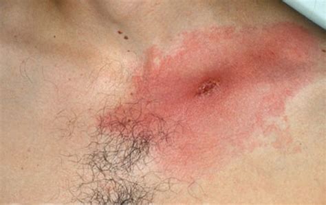 Lyme Disease Rash Causes Symptoms Diagnosis And Treatment