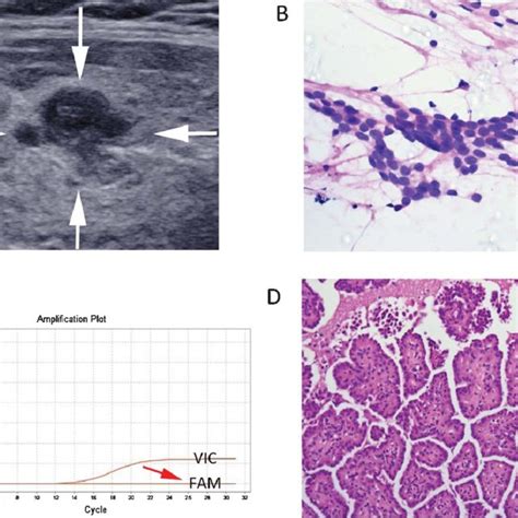 The Diagnostic Algorithm Of Thyroid Nodules With Ausflus Cytology